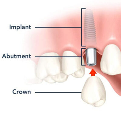 Root Canal Treatment